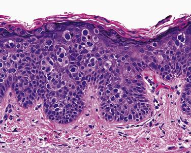 FIG. 23.30, Squamous carcinoma in situ (Bowen disease), pagetoid type. Isolated cells throughout the epidermis similar to Paget disease and superficial spreading melanoma. There are also a few clones of atypical cells.