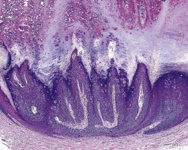 FIG. 23.3, Verruca plantaris. Endophytic papillomatous lesion with hypergranulosis.