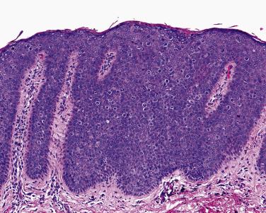 FIG. 23.31, Bowenoid papulosis. Solitary or grouped papules with full-thickness atypia and a retained maturation pattern.