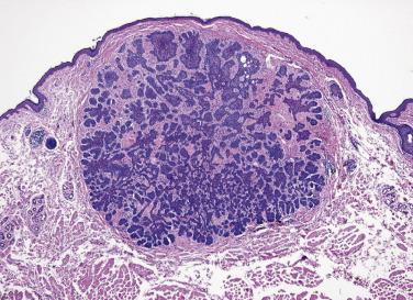 FIG. 23.32, Basal cell carcinoma, common type. There is a nodule composed of insular, basaloid cells.