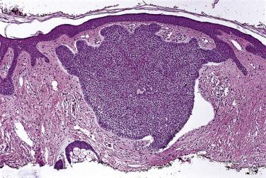 FIG. 23.33, Basal cell carcinoma. Note the retraction artifact.