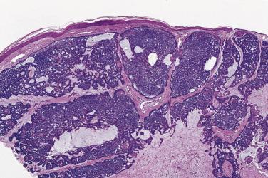 FIG. 23.34, Basal cell carcinoma, mucinous. Mucinous zones are present in the stroma of this lesion.