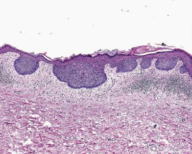 FIG. 23.35, Basal cell carcinoma, superficial type. Budlike nests of basaloid cells connect to the epidermis across a broad front.