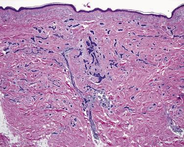 FIG. 23.36, Basal cell carcinoma, morpheic type. Thin basaloid strands within desmoplastic stroma.