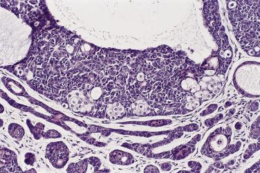 FIG. 23.37, Basal cell carcinoma, with sebaceous zones. This unusual variant may be included in the spectrum of low-grade sebaceous tumors.