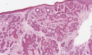 FIG. 23.38, Basal cell carcinoma, infundibulocystic variant. This variant shows infundibular cysts and basaloid cells, similar to rudimentary follicular bulbs and papillae, arranged in small, uniform aggregates and anastomosing cords.