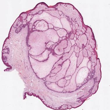 FIG. 23.39, Basal cell carcinoma, fibroepithelioma of Pinkus type. The tumors are characterized by tumor islands and anastomosing strands of basaloid, often palisading cells, embedded in a fibromatous stroma.