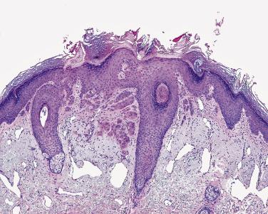 FIG. 23.40, Squamous cell carcinoma, usual type. Branching lobules extend from an ulcerated surface in this lesion.