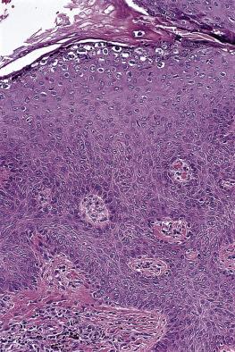 FIG. 23.4, Condyloma acuminatum. Note the superficial koilocytotic cells. There is also keratinocytic maturation in a broad pattern.