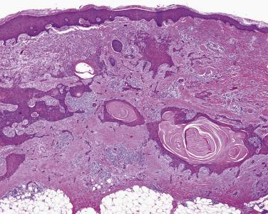 FIG. 23.41, Squamous cell carcinoma, usual type. Prominent parakeratotic horn cysts (pearls) are present in this lesion.