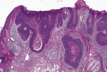 FIG. 23.44, Squamous cell carcinoma, bowenoid type. This carcinoma is similar to Bowen disease, but is present within the dermis.