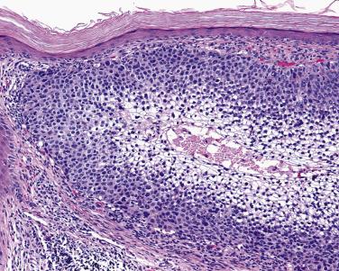 FIG. 23.45, Squamous cell carcinoma, clear cell type. Lobules of nonkeratinizing squamous cell carcinoma with central clear cell cytology.