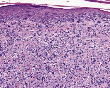 FIG. 23.46, Squamous cell carcinoma, infiltrative. This lesion has sheets of highly pleomorphic cells without obvious keratinization. The lesion closely resembles an atypical fibroxanthoma but the neoplastic cells are positive for keratin.