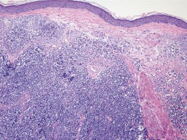 FIG. 23.47, Merkel cell carcinoma. Dermal-based neoplasm composed of blue rounded cells.