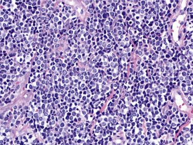 FIG. 23.48, Merkel cell carcinoma. The tumor cells are midsize, and show uniform nuclei with finely dispersed chromatin.