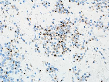 FIG. 23.49, Merkel cell carcinoma. The tumor cells exhibit staining for CK20 with a classic perinuclear dotlike pattern.