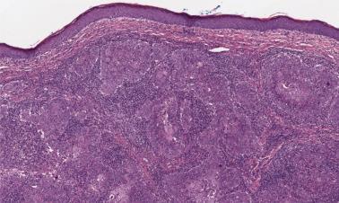 FIG. 23.50, Lymphoepithelial carcinoma. The tumor is composed of islands of epithelial cells with large vesicular nuclei surrounded and permeated by a dense lymphoplasmacytic infiltrate.