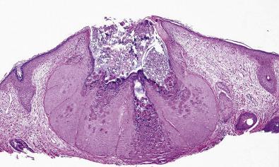 FIG. 23.5, Molluscum contagiosum. Endophytic epithelium with numerous spheric molluscum (Henderson-Patterson) bodies emerging from the superficial aspects of the follicle.