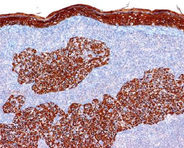 FIG. 23.51, Lymphoepithelial carcinoma. The tumor nests are highlighted by a CK(AE1/AE3) immunostain.