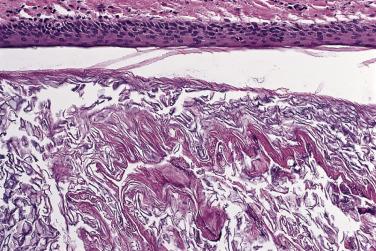 FIG. 23.53, Keratinous cyst, infundibular type. Delicate keratin similar to the surface.