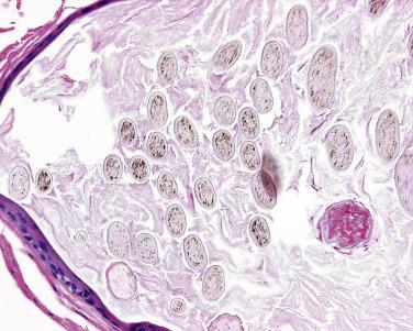 FIG. 23.56, Eruptive vellus hair cyst. Thin epithelium with small hair shafts and variable keratin.