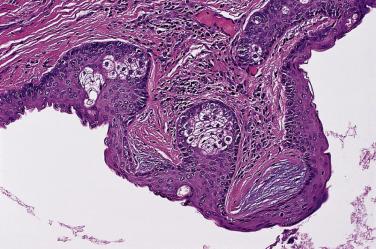 FIG. 23.57, Steatocystoma. Corrugated cyst cuticle and sebaceous glands within the cyst wall. These may have overlapping features with eruptive vellus hair cyst.