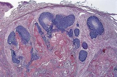 FIG. 23.58, Pilomatricoma. The tumor is composed of basaloid cells with pink shadow cells.