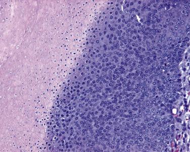 FIG. 23.59, Pilomatricoma. The basaloid cells make a transition into shadow cells.