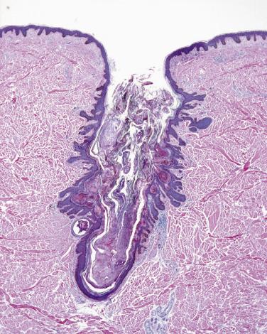 FIG. 23.60, Dilated pore (Winer). Invaginated and widened opening filled with orthokeratotic keratin.