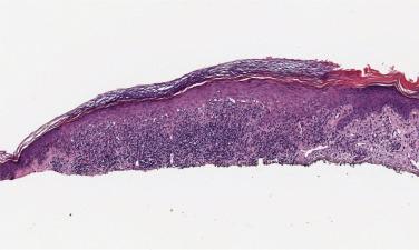 FIG. 23.6, Lichenoid keratosis. Lichenoid lymphohistiocytic infiltrate with a bandlike appearance.