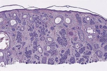 FIG. 23.62, Trichoepithelioma, classic. Note the symmetry, the cysts, and the variety of basaloid epithelial elements.