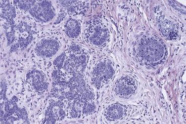 FIG. 23.63, Trichoepithelioma, classic. There are several hair germs with papillary mesenchymal bodies within a fibrotic stroma.