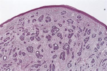 FIG. 23.64, Trichoblastic fibroma. Numerous trichoblasts, or hair germs, exist within a fibrous stroma. We view this as an immature variant in the trichoepithelioma spectrum.