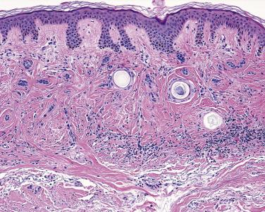 FIG. 23.66, Desmoplastic trichoepithelioma. Thin basaloid strands and small keratinizing cysts in a desmoplastic stroma.