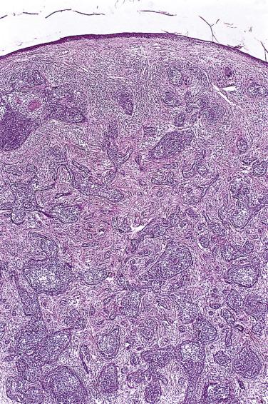 FIG. 23.67, Lymphadenoma. The lesion is composed of islands rimmed by basaloid cells. The islands contain numerous lymphocytes and histiocytes.