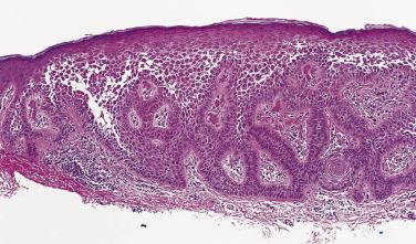 FIG. 23.7, Acantholytic acanthoma. This lesion is similar to a seborrheic keratosis but is acantholytic throughout the epidermis.