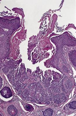 FIG. 23.8, Warty dyskeratoma. Cup-shaped lesion with acantholysis and villi, similar to Darier disease.