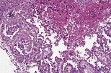 FIG. 23.9, Warty dyskeratoma. Note the papillary projections of the dermis lined by epidermis (villi).