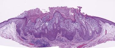 FIG. 23.10, Epidermolytic acanthoma. There is prominent epidermolytic hyperkeratosis in this verrucous lesion.