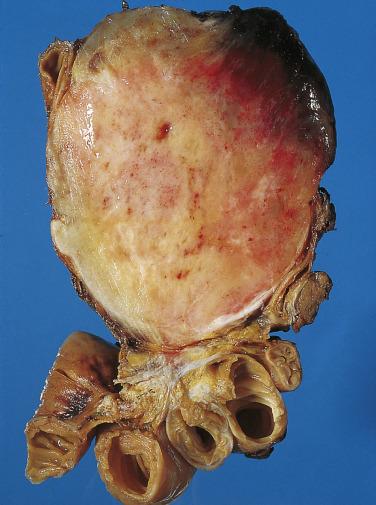 FIG. 9.11, Mesenteric desmoid fibromatosis. This large tumor is grossly circumscribed.