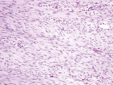 FIG. 9.12, Desmoid fibromatosis composed of long fascicles of uniform spindle cells.