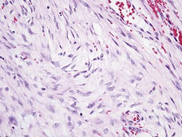 FIG. 9.13, Mesenteric desmoid fibromatosis often shows focally myxoid stroma. Note the plump, stellate nuclei with small nucleoli.