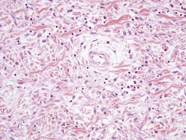 FIG. 9.16, Inflammatory fibroid polyp of the ileum. The tumor is composed of spindled to stellate cells in an edematous stroma with scattered lymphocytes and eosinophils.