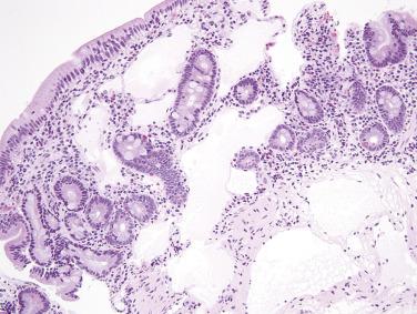 FIG. 9.17, Lymphangioma of the duodenum. The lymphatic channels involve the mucosa and submucosa.