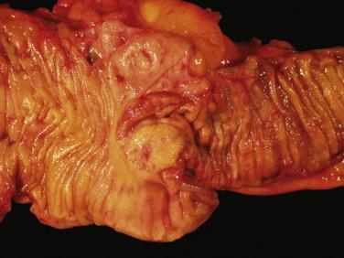 FIG. 9.2, Neuroendocrine tumor adjacent to the ileocecal valve. The tumor is well circumscribed with a yellow cut surface.