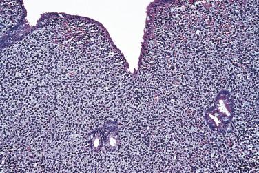 FIG. 9.21, Immunoproliferative small intestinal disease. The lamina propria is expanded by an infiltrate of lymphoplasmacytic cells.