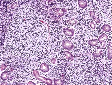 FIG. 9.22, Duodenal-type follicular lymphoma. The nodular lymphoid infiltrate is composed of uniform small cells.