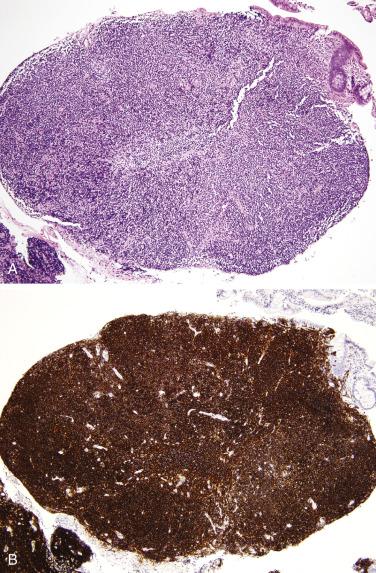 FIG. 9.23, (A) Mantle cell lymphoma presenting as lymphomatous polyposis. (B) The lymphoid cells are nearly entirely CD20-positive B cells.