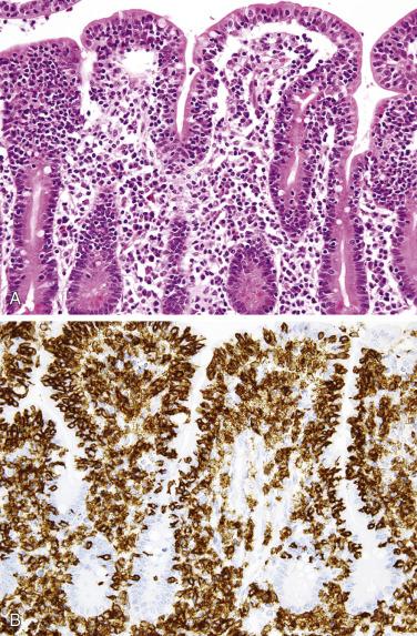 FIG. 9.28, Striking intraepithelial lymphocytosis adjacent to monomorphic epitheliotropic intestinal T-cell lymphoma (A). CD8 is positive (B), contrasting this lymphoma with conventional enteropathy-associated T-cell lymphoma.