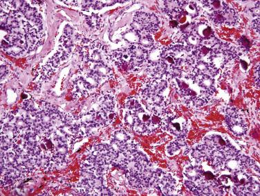 FIG. 9.4, Somatostatin-producing neuroendocrine tumor of the duodenum showing glandular architecture and frequent psammoma bodies.